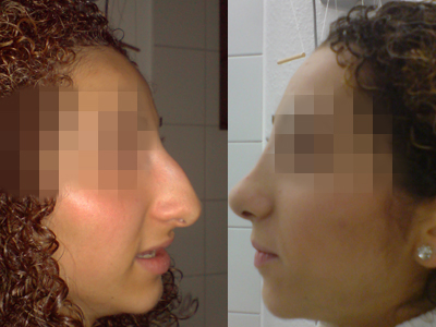 Nase2-Edit